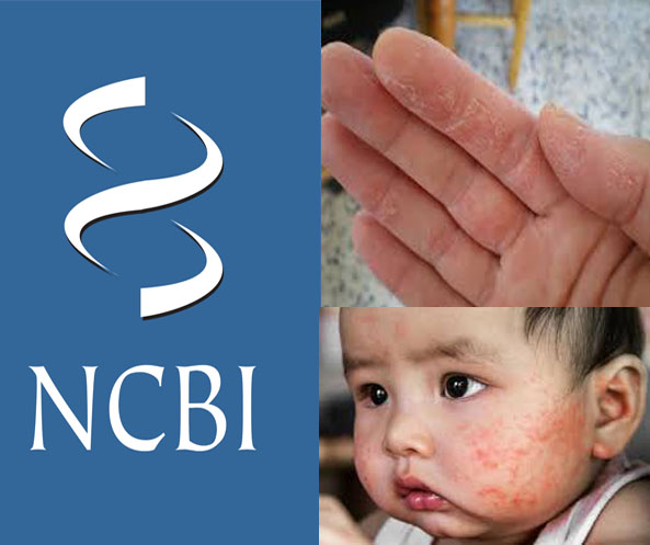 SLS làm bệnh chàm, vẩy nến, viêm da cơ địa trầm trọng hơn